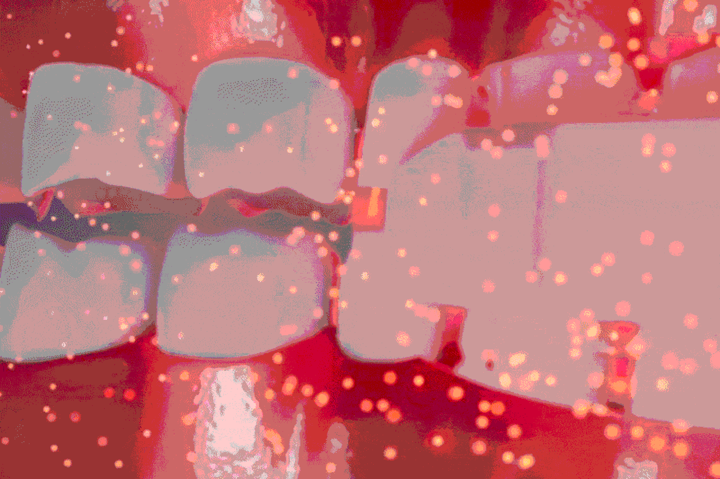 Protocole Gingival SERALLIA™