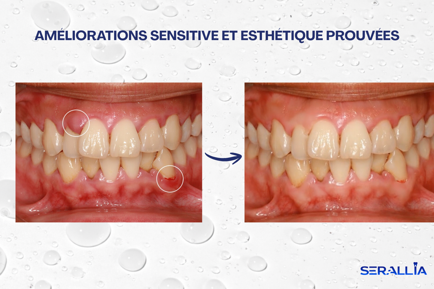 Protocole Gingival SERALLIA™